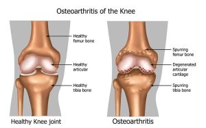 Osteoarthritis Of The Knee