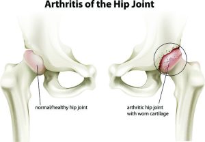 Arthritis of The Hip Joint