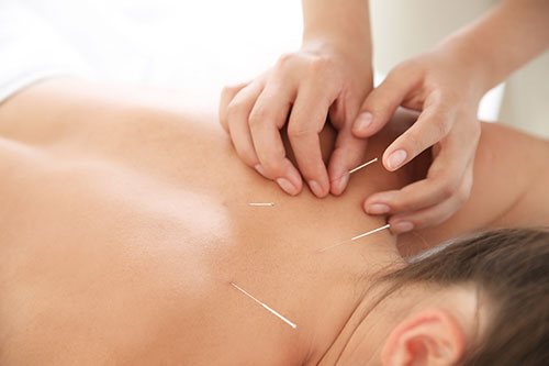 Dry Needling Treatment in Tucson AZ